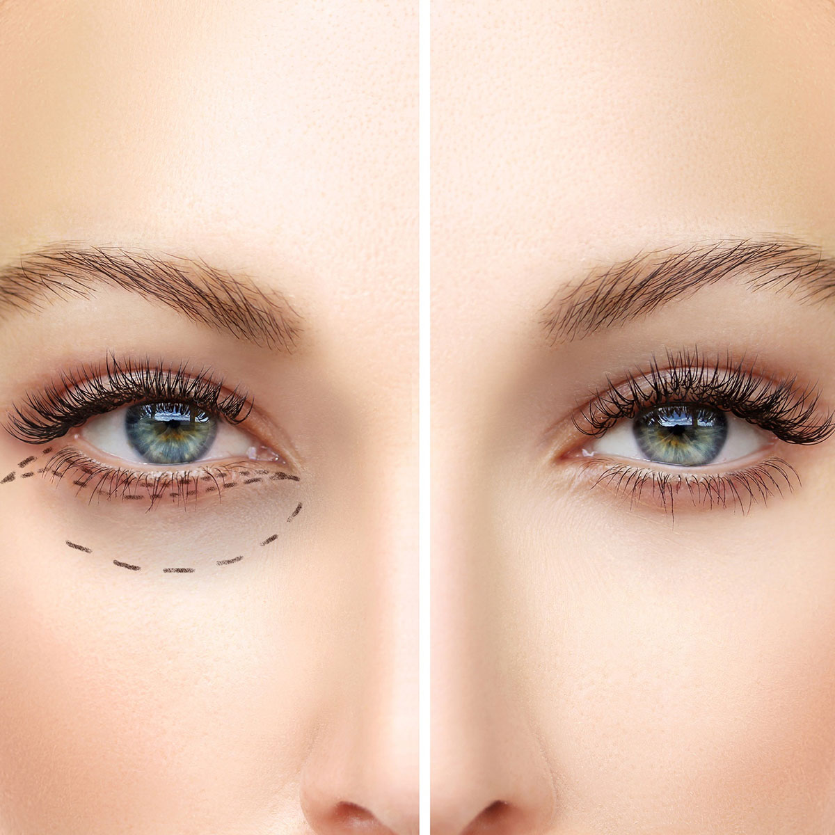 what helps droopy eyelids after botox