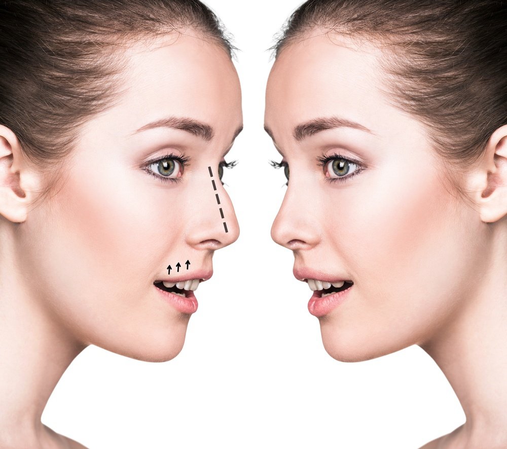 nose surgery - Rhinoplasty