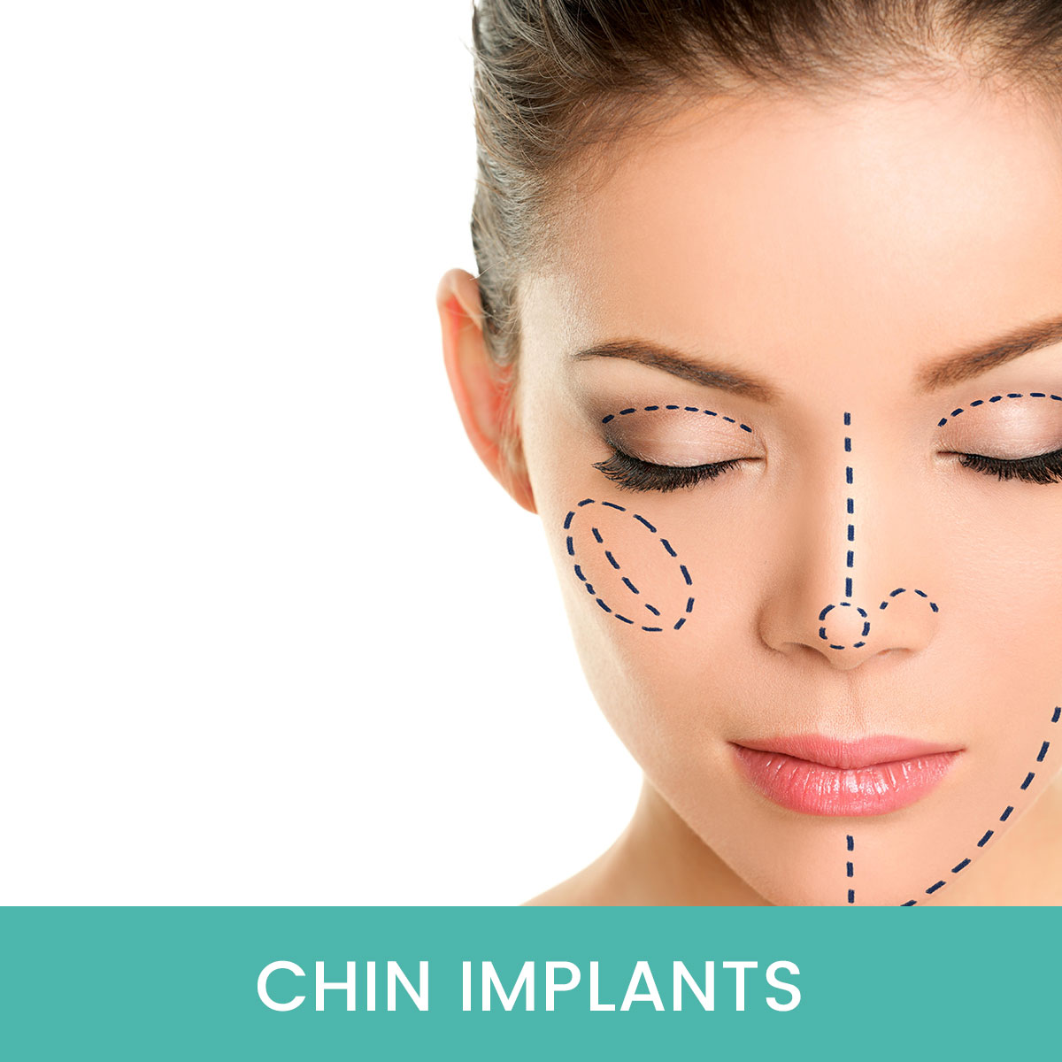 Chin-Implants-Dubai-UAE