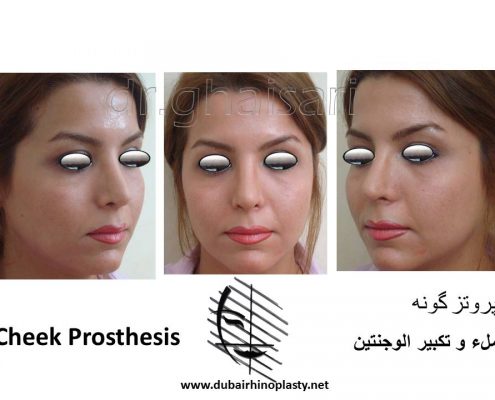 Cheek Prosthesis Before After