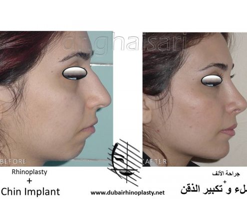 Chin Implants Before After