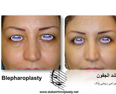 Blepharoplasty Before After