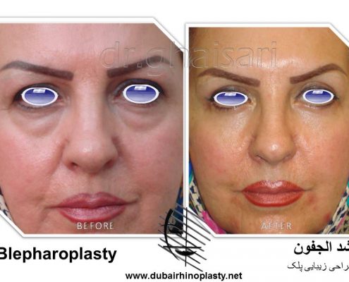 Blepharoplasty Before After