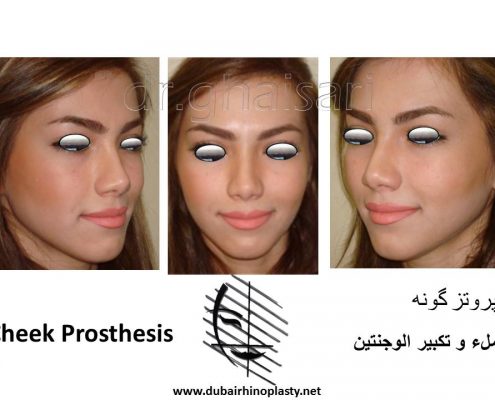 Cheek Prosthesis Before After