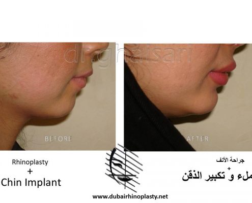Chin Implants Before After